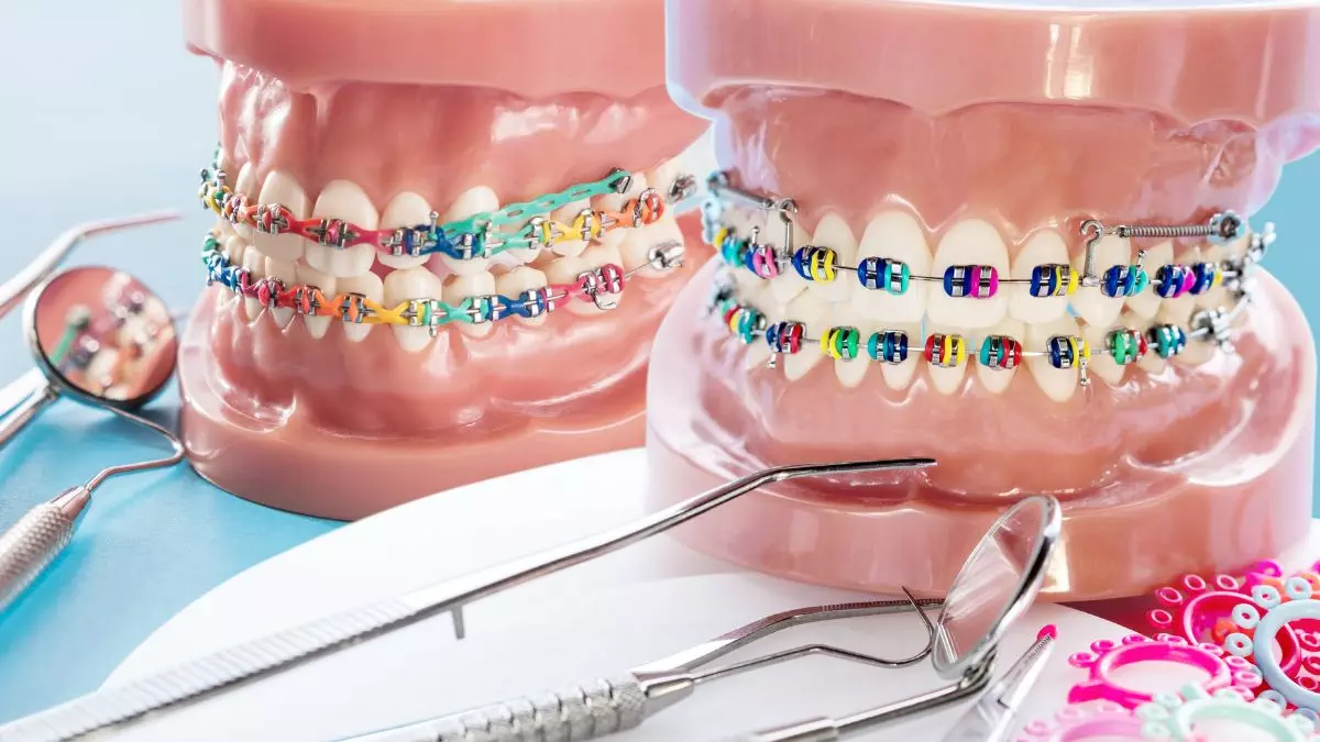 Best Braces Colors - What Are Some Good Colors For Braces