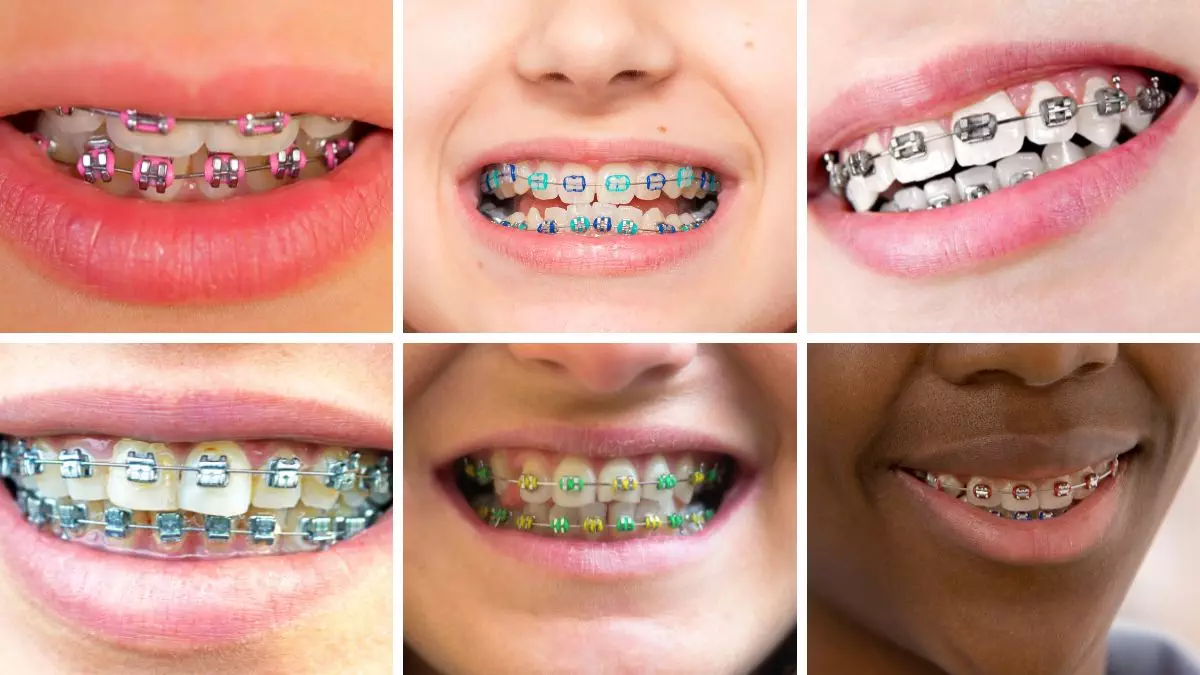 The Best Braces Colors To Brighten Your Smile
